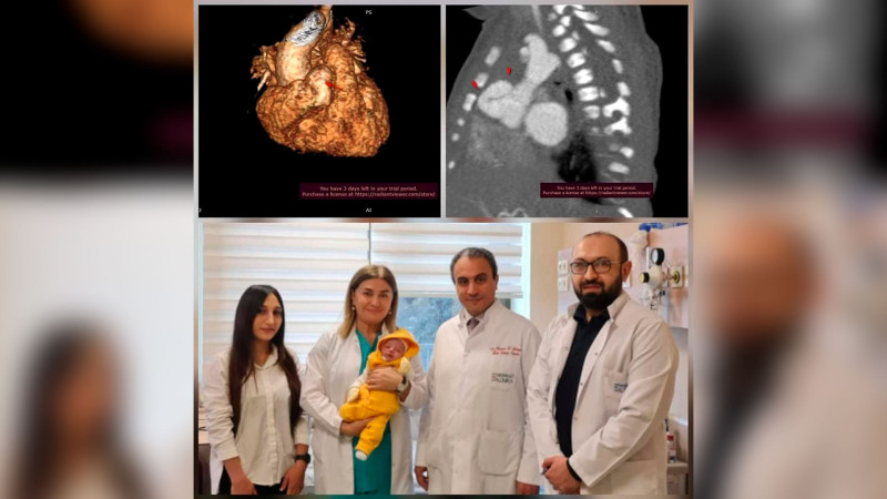 Bakı klinikasında 9 günlük körpə ürəkdən əməliyyat olunub