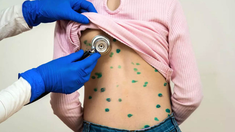 Bakıda məktəblilər arasında suçiçəyi epidemiyası yayılır