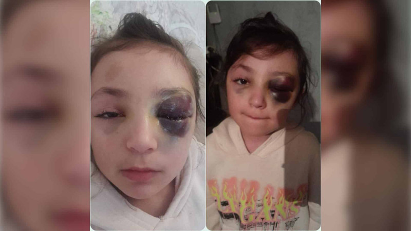 Ramanada ikinci sinif şagirdi gözündən ağır zədə alıb