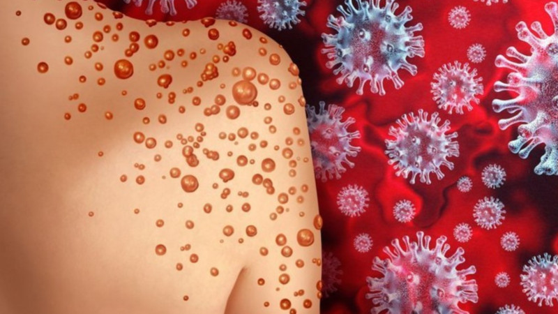 Azərbaycanda bir nəfərdə meymunçiçəyi virusu aşkarlanıb - RƏSMİ