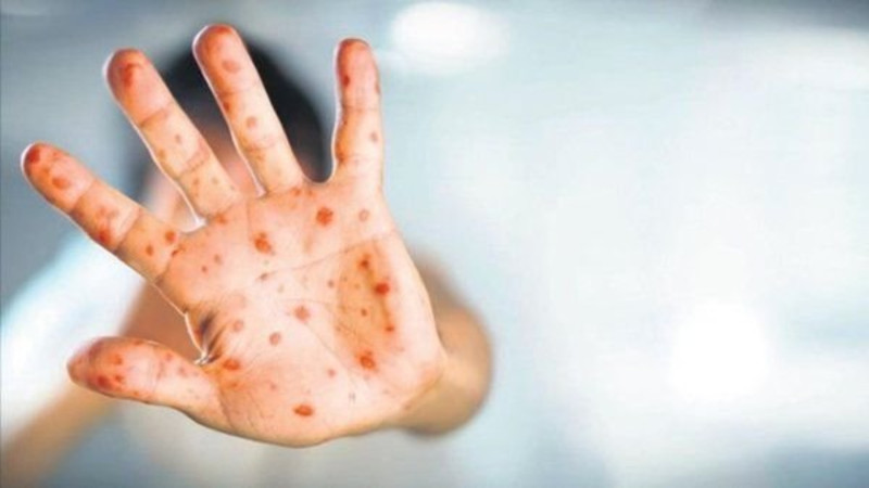 “Meymunçiçəyi yüngül gedişatlı xəstəlikdir” - Həkimdən açıqlama 