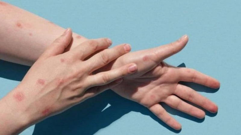 Meymunçiçəyinə yoluxan Azərbaycan vətəndaşının son vəziyyəti AÇIQLANDI