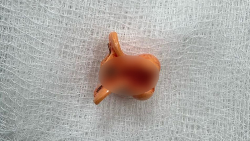 2 yaşlı uşaq saç sancağı uddu - FOTO 