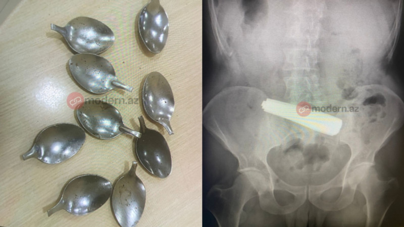 Bakıda bir nəfər 9 qaşıq uddu - DƏHŞƏTLİ hadisə - FOTO Bakıda bir nəfər 9 qaşıq uddu - DƏHŞƏTLİ hadisə - FOTO