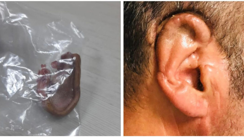 Bakıda kişinin qulağı qopdu - 34 saat sonra yerinə tikdilər + FOTO