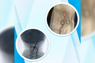 Bakıda qayçı udan şəxsin vəziyyəti orta ağır qiymətləndirilir