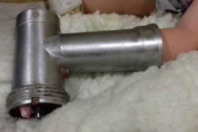 Bakıda dəhşətli olay: 2 yaşlı körpənin əli ətçəkən maşında qalıb