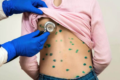 Bakıda məktəblilər arasında suçiçəyi epidemiyası yayılır