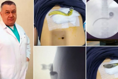 10 yaşlı uşağın qarın boşluğuna qapı dəstəyi məktəbdə BATIB – Hadisənin TƏFƏRRÜATI