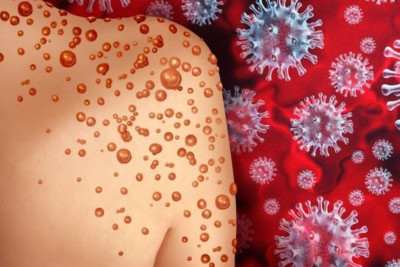 Azərbaycanda bir nəfərdə meymunçiçəyi virusu aşkarlanıb - RƏSMİ