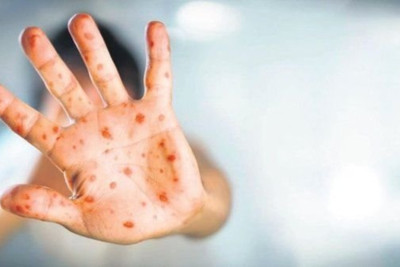 “Meymunçiçəyi yüngül gedişatlı xəstəlikdir” - Həkimdən açıqlama 