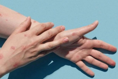 Meymunçiçəyinə yoluxan Azərbaycan vətəndaşının son vəziyyəti AÇIQLANDI