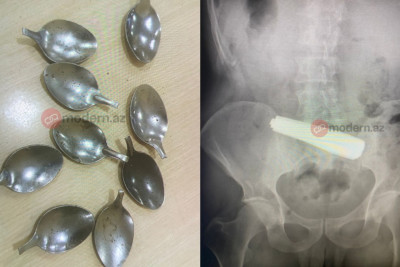 Bakıda bir nəfər 9 qaşıq uddu - DƏHŞƏTLİ hadisə - FOTO