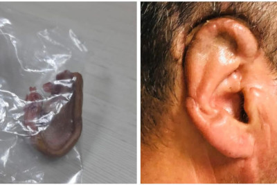 Bakıda kişinin qulağı qopdu - 34 saat sonra yerinə tikdilər + FOTO